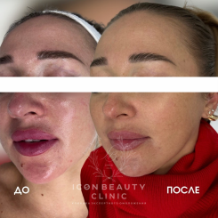 Контурная пластика губ 4